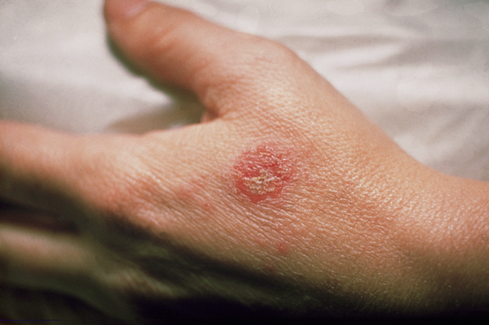 Apa itu Eczema? Simak Penjelasan Lengkap Berikut